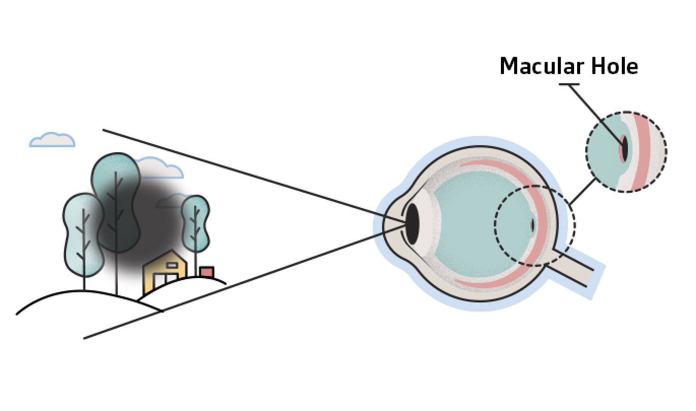 Macular Hole: Symptoms, Causes, & Treatment