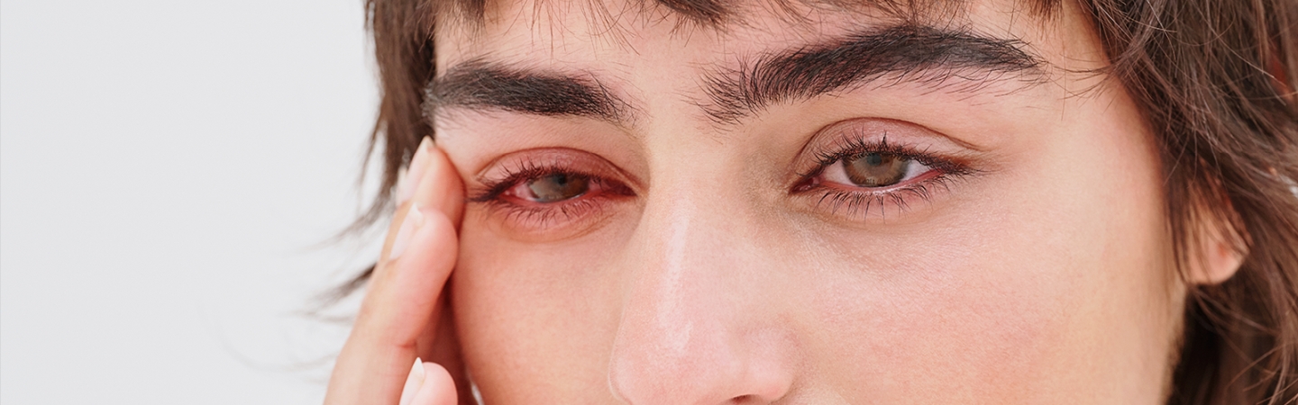 Øjenbetændelse (konjunktivitis) | Læs om betændelse øjet |